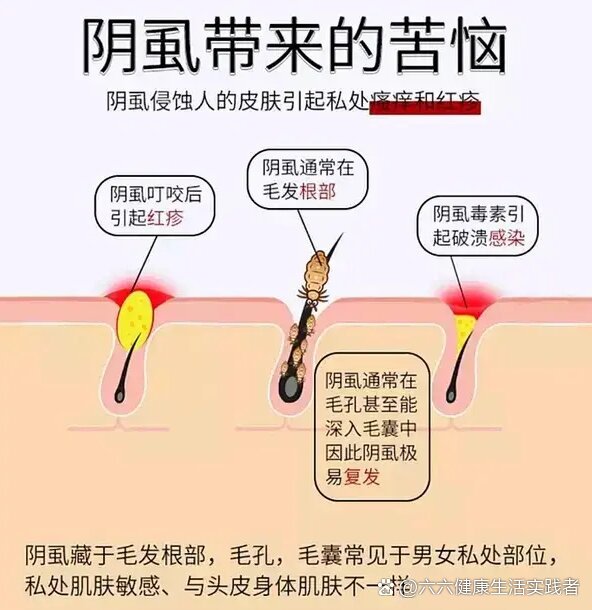 阴虱是什么原因引起的
