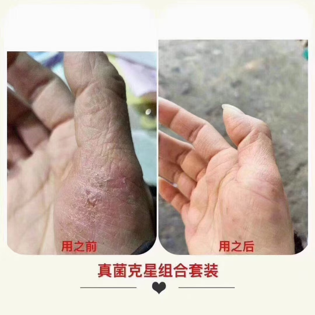 手廯要怎么治