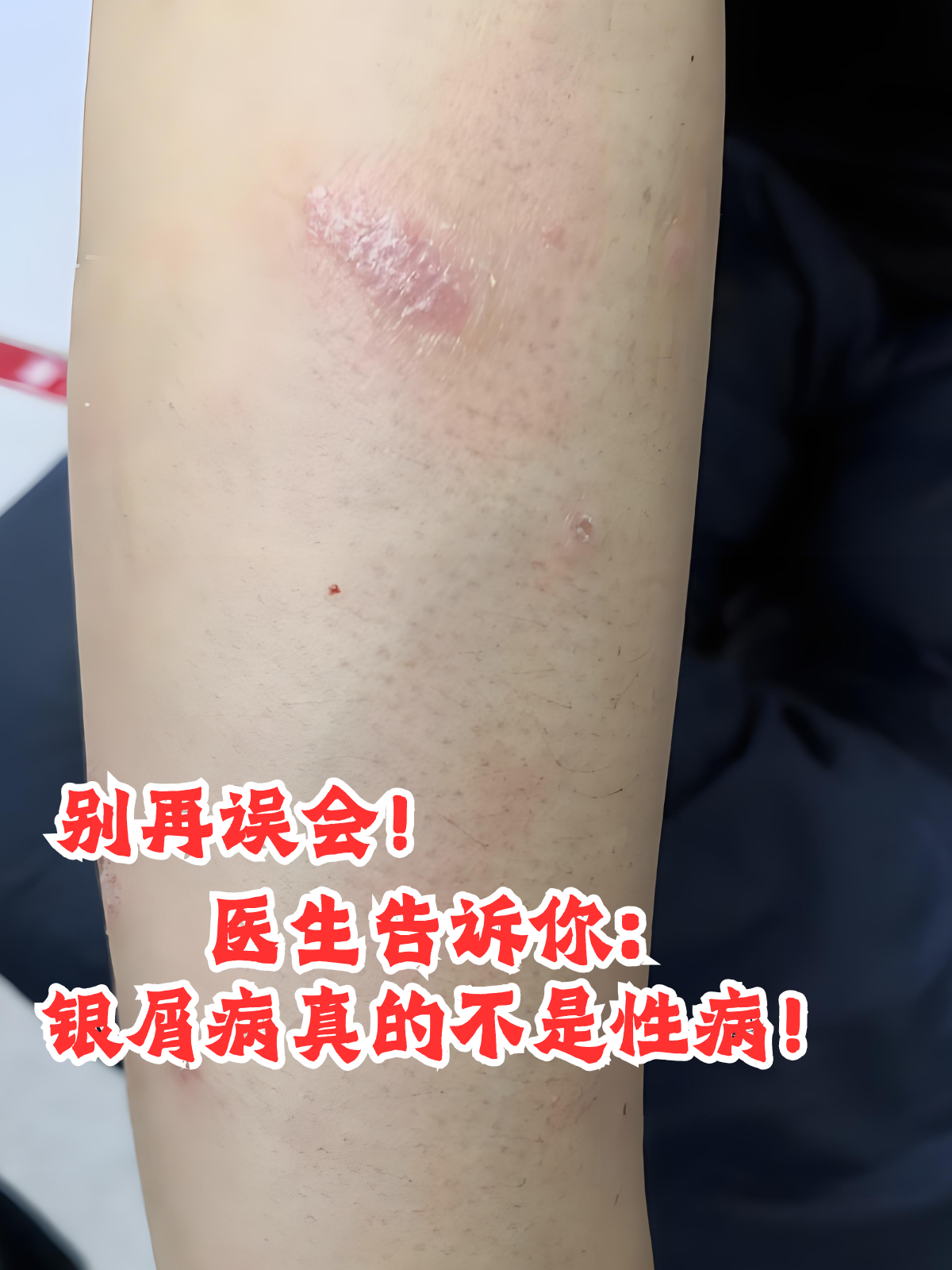 牛皮癣会传染吗