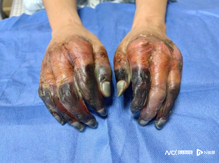 手指冻伤的治疗方法是什么?