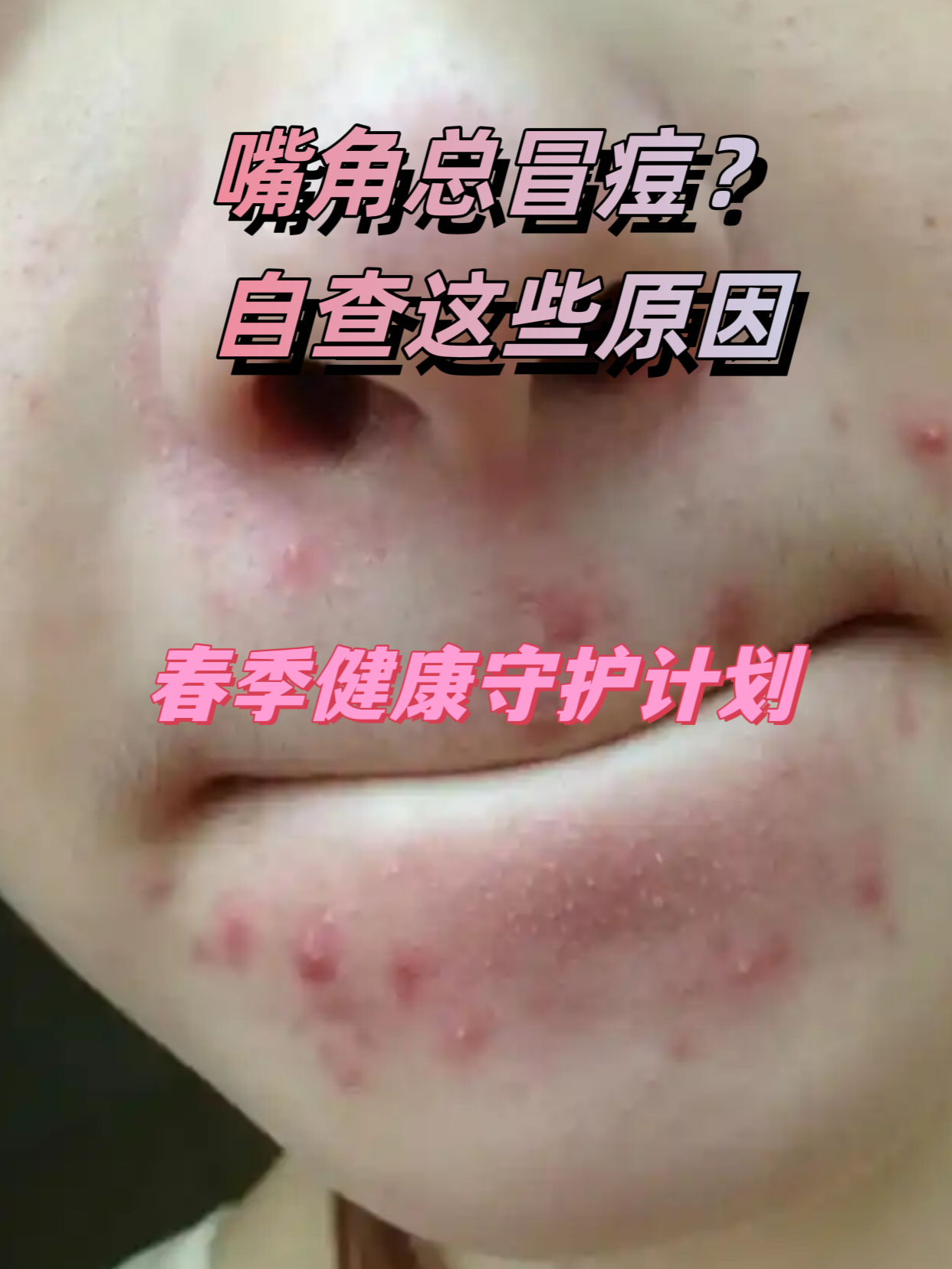 嘴上方长痘的原因有哪些