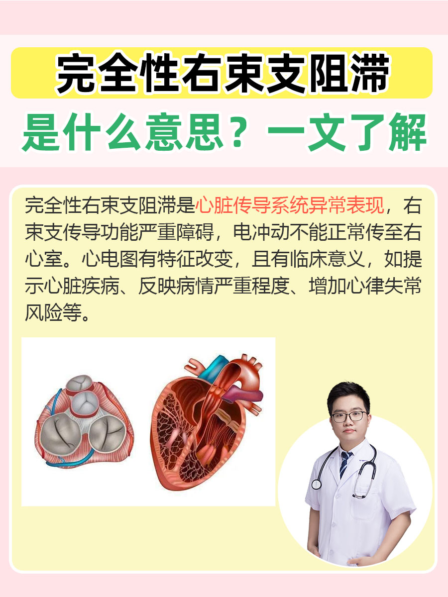 完全性右束支传导阻滞心电图表现