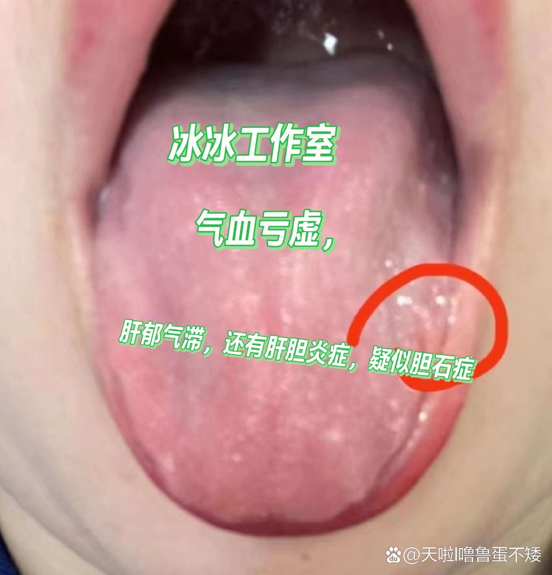 胆管结石症状表现