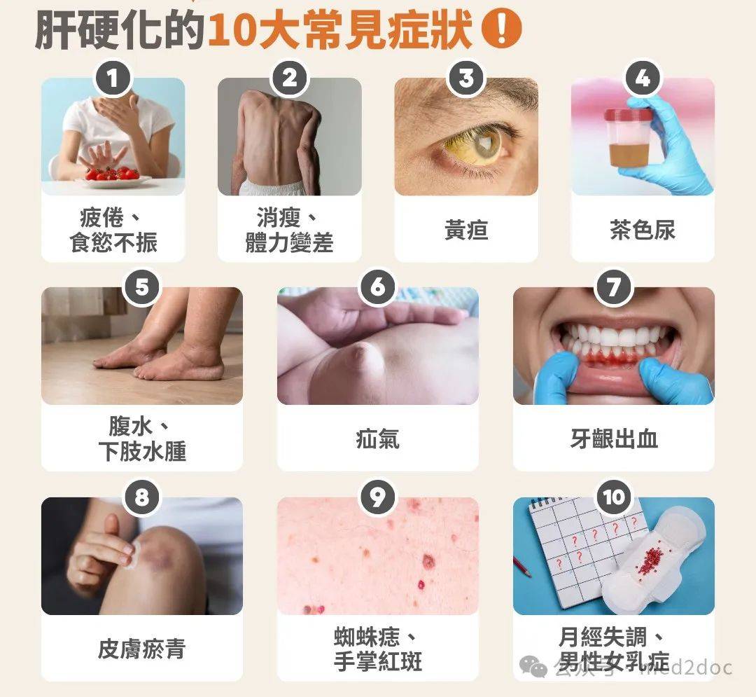 脂肪肝的主要表现