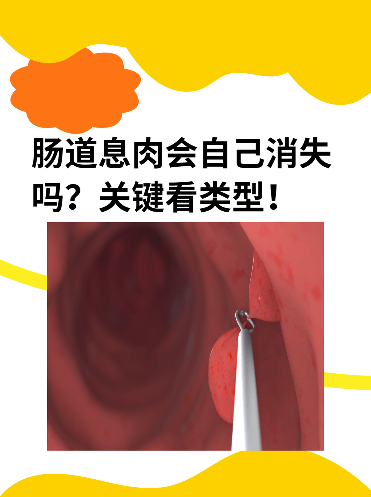 肠息肉一定要做手术吗