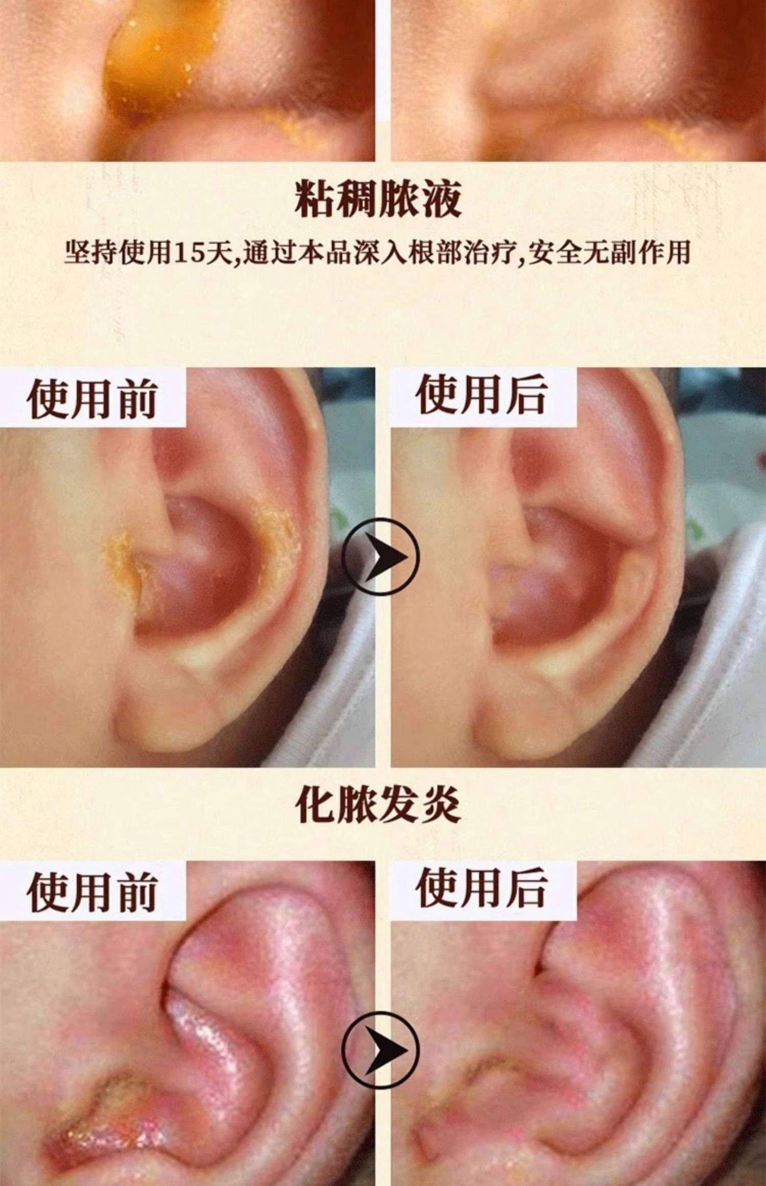 耳朵流脓怎么治疗