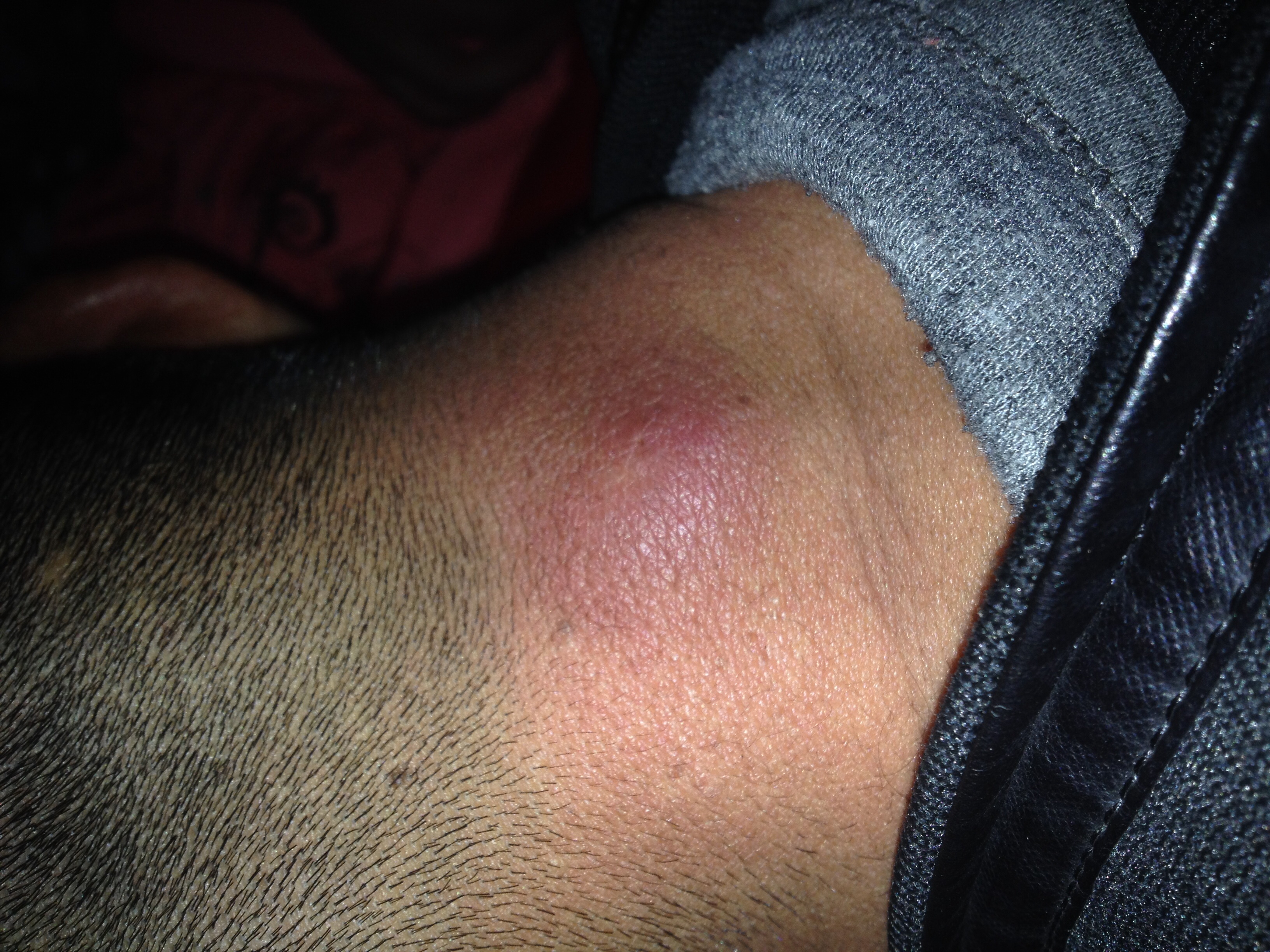 脖子后面有疙瘩