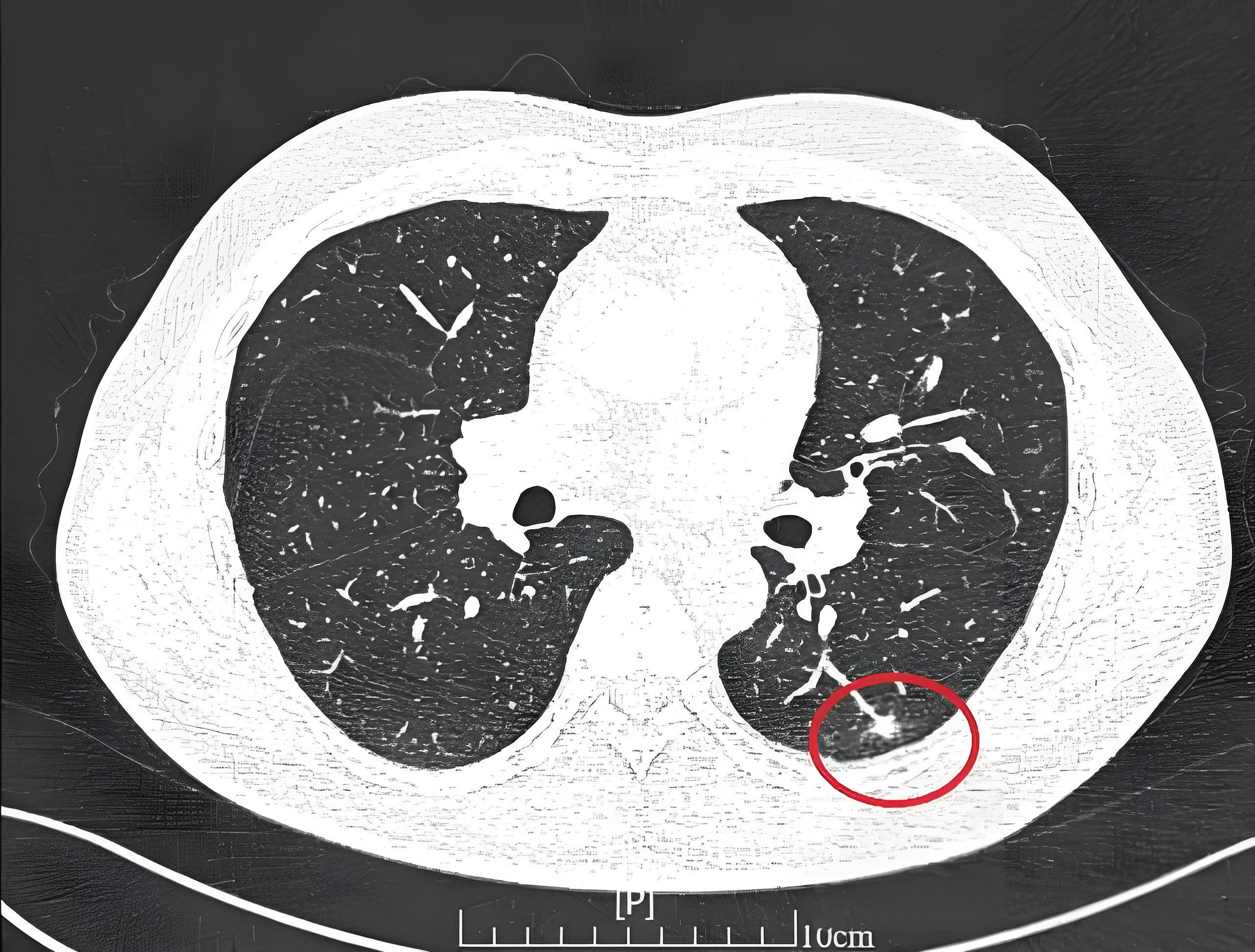 肺结节影什么意思