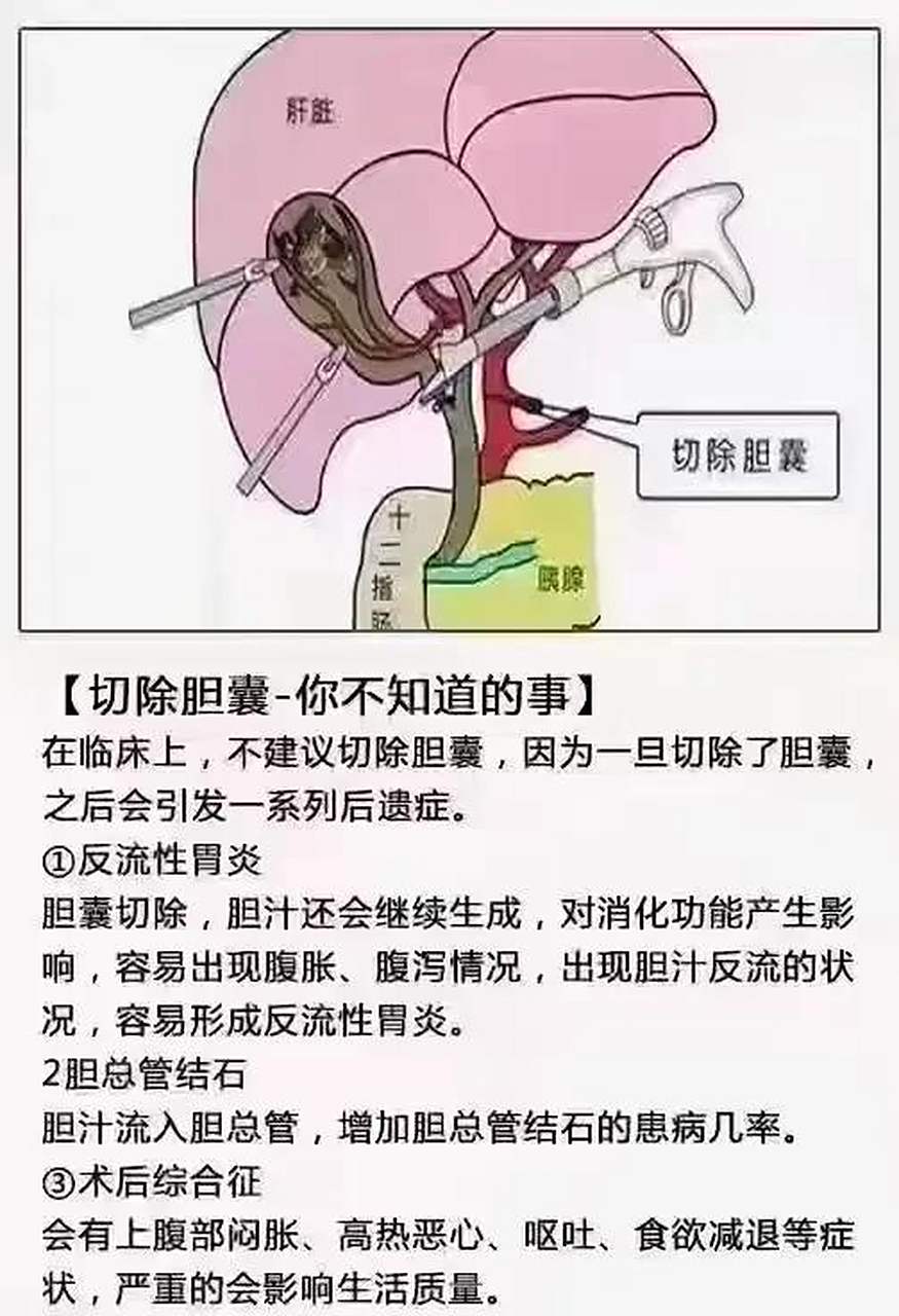 胆囊切除的危害有哪些?