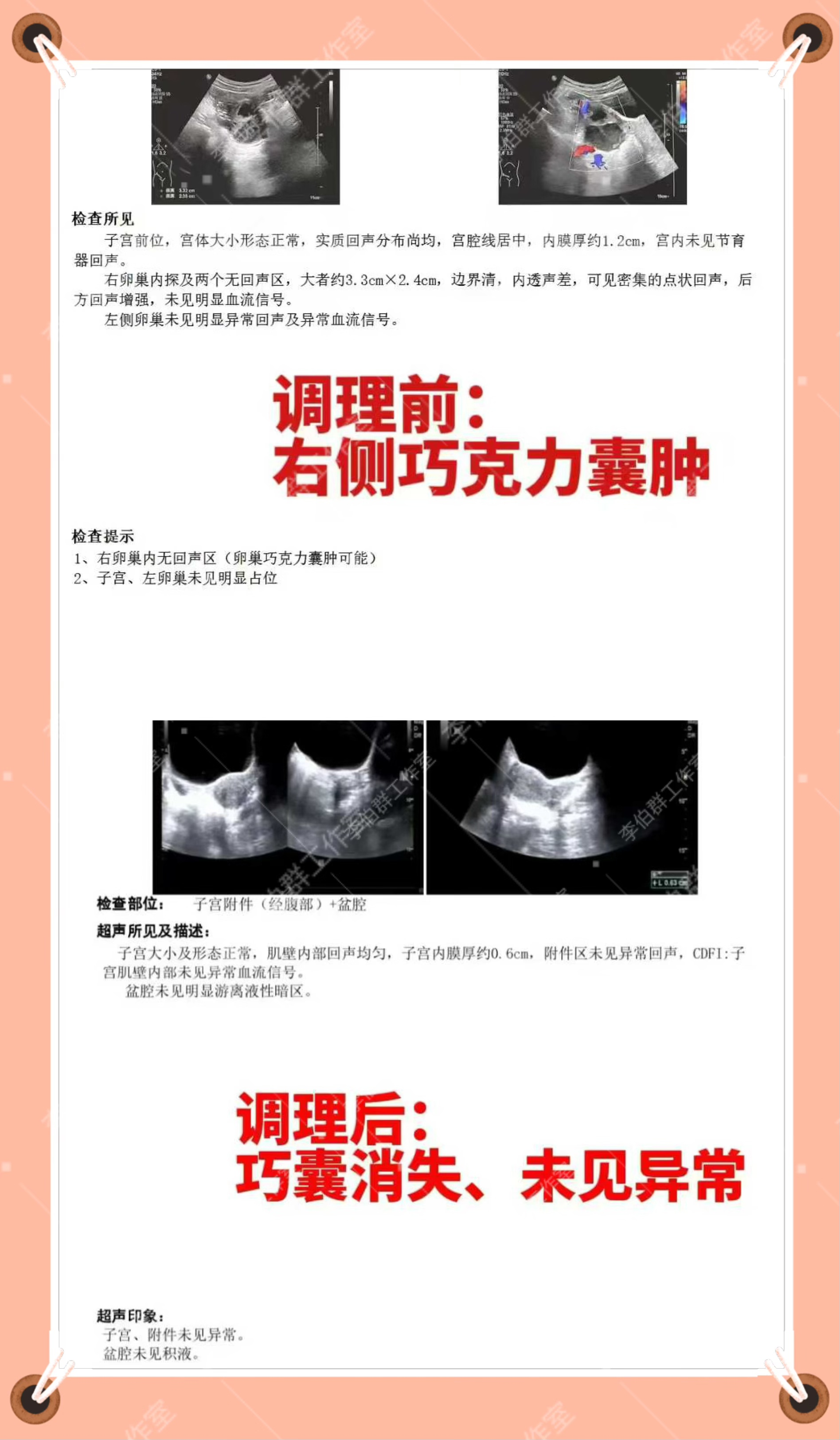 巧克力囊肿怎么治疗?
