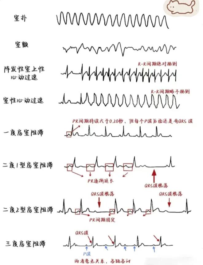 房性心动过速的心电图表现有哪些