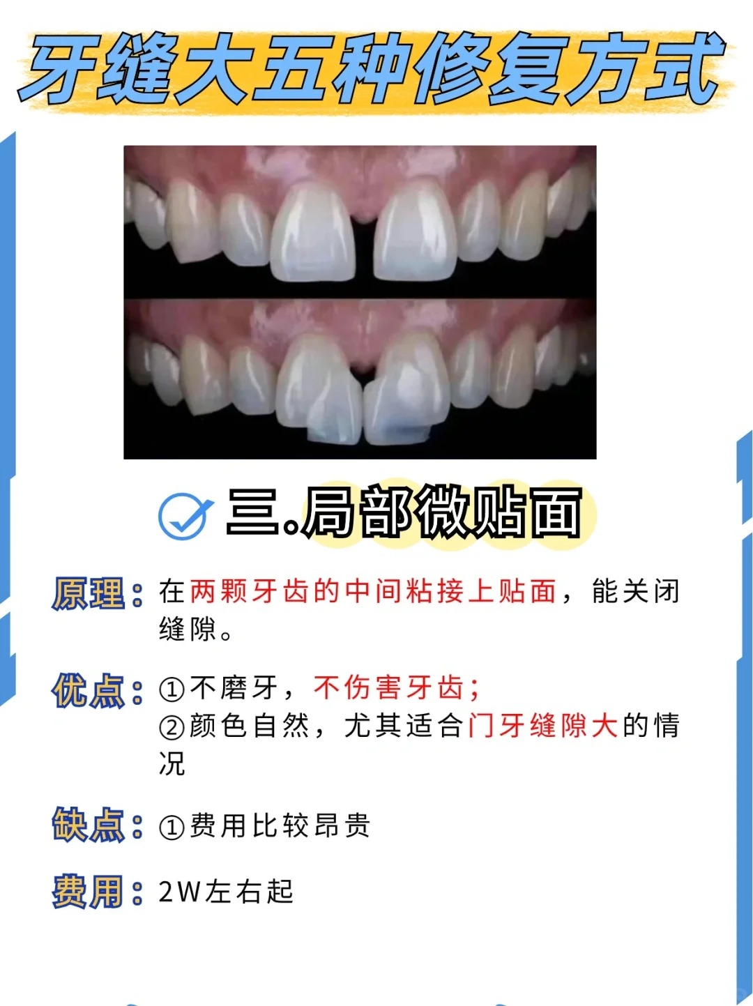 门牙中间有缝怎么办
