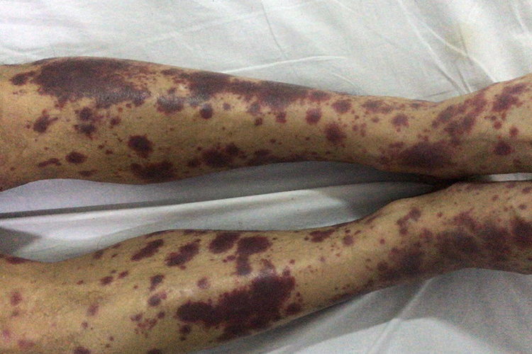 血小板减少严重吗?有什么症状