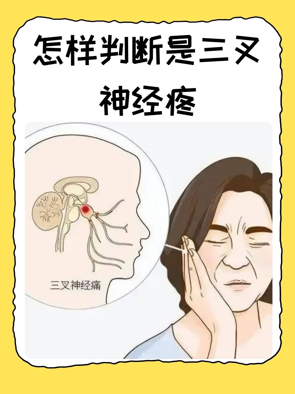 面部神经痛怎么办