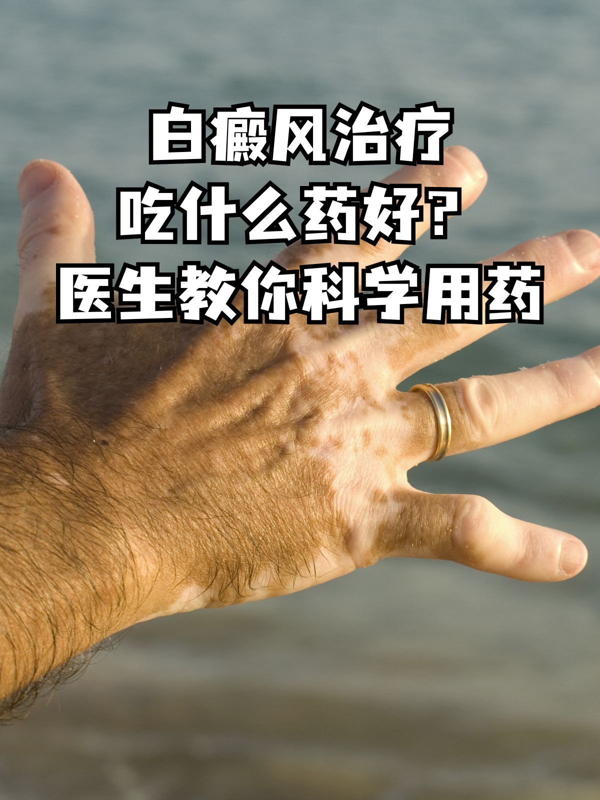 白癜风是会传染的吗?