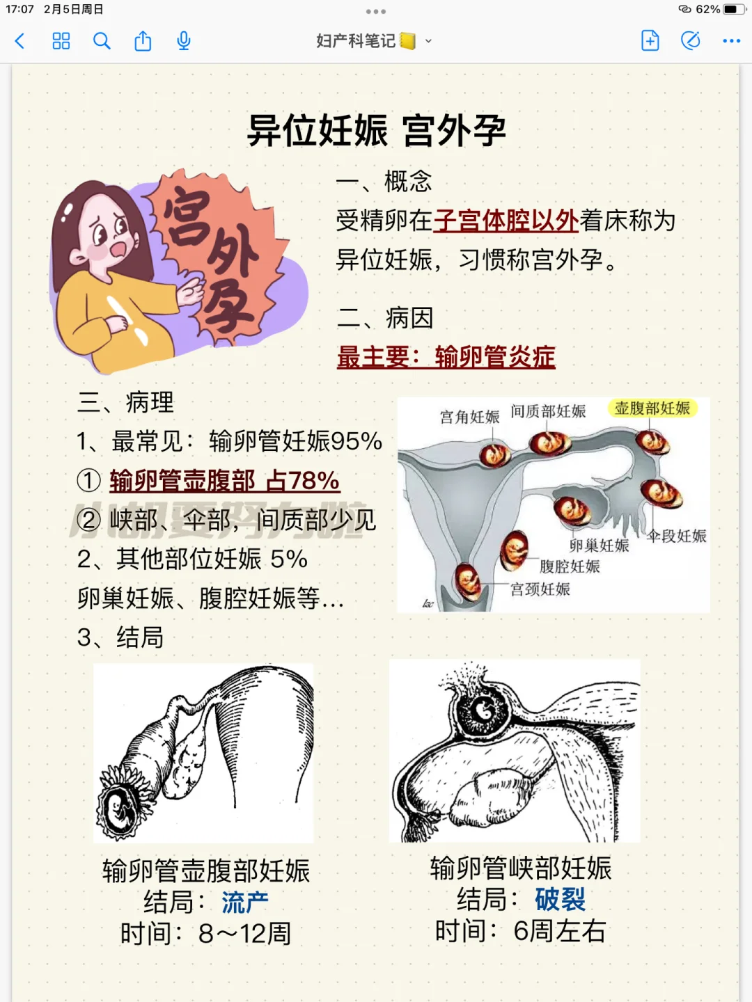 宫外孕能生下来吗?