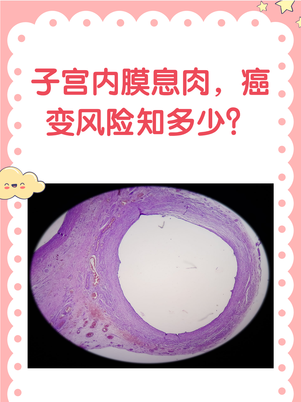 什么是子宫内膜息肉?