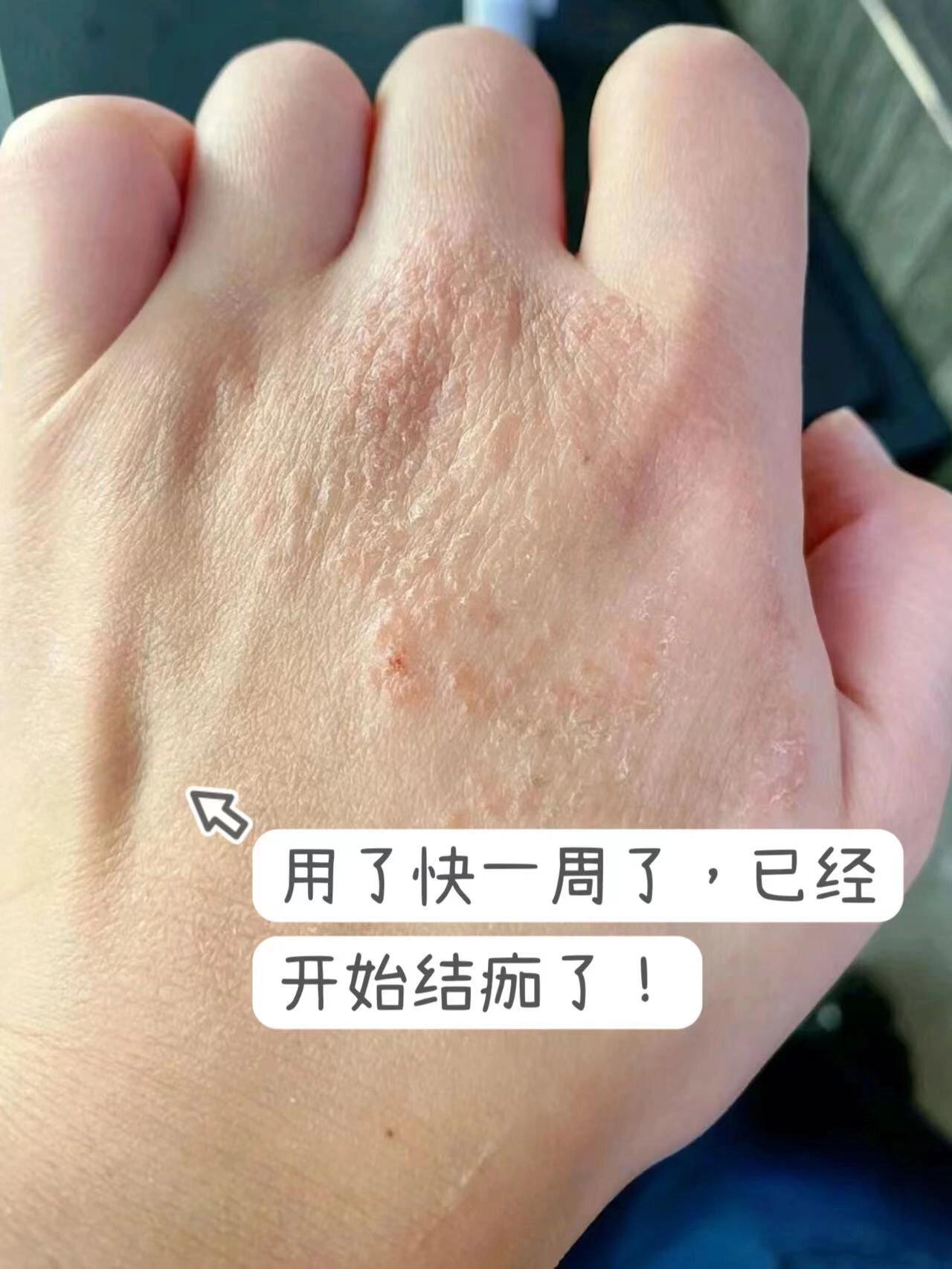 手上起水泡到底怎么回事