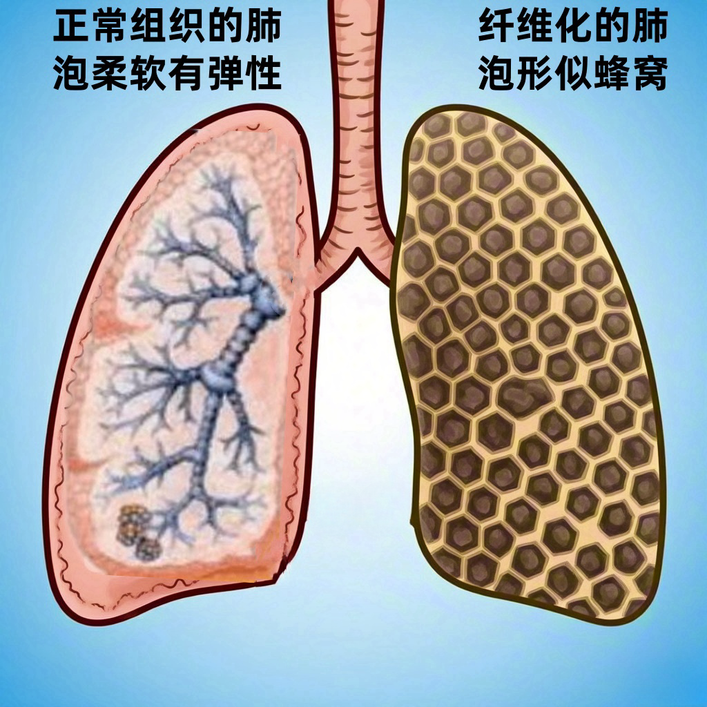 肺间质性纤维化存活期是多久