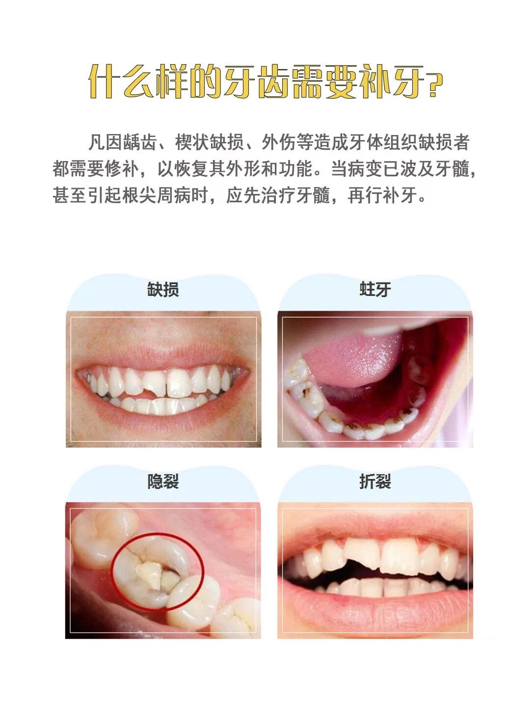 根管治疗需要多长时间