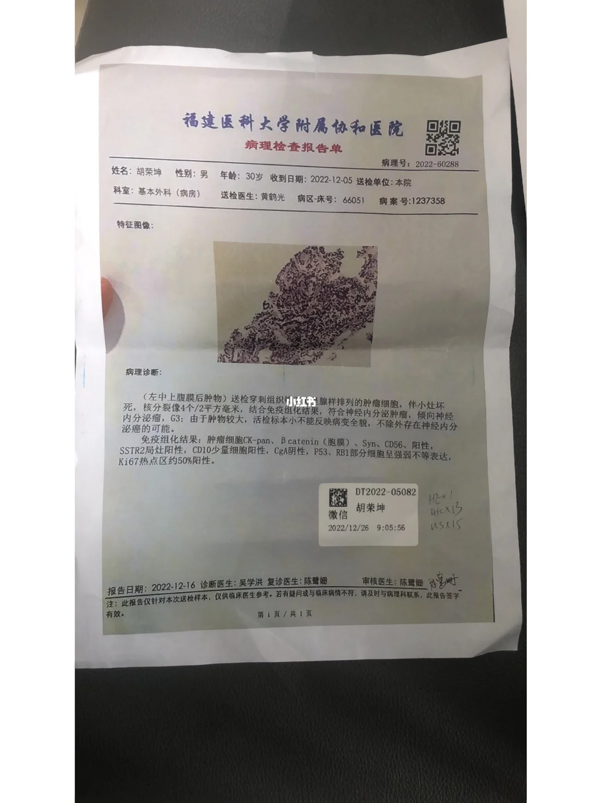 生殖细胞瘤