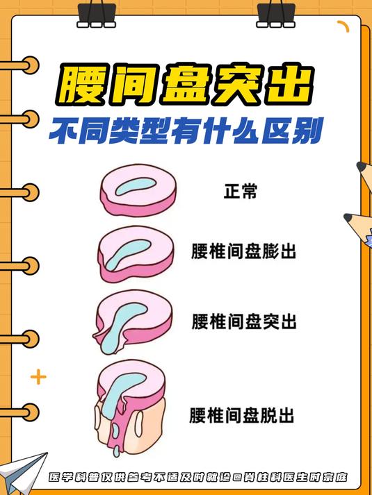 腰椎间盘突出的分型及临床表现