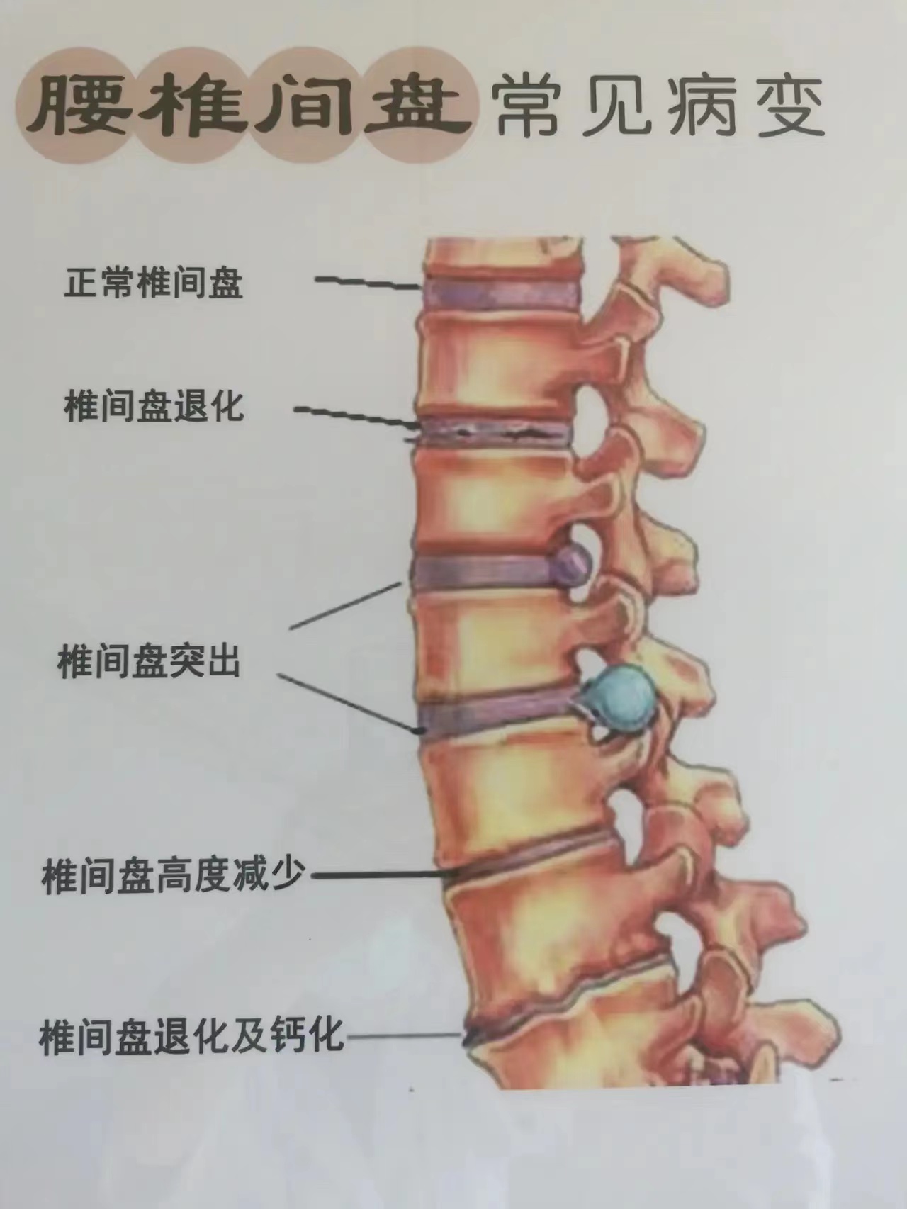 腰椎间盘突出的分型及临床表现