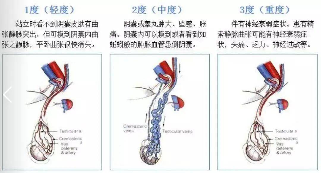 精索静脉曲张手术后多久可以恢复