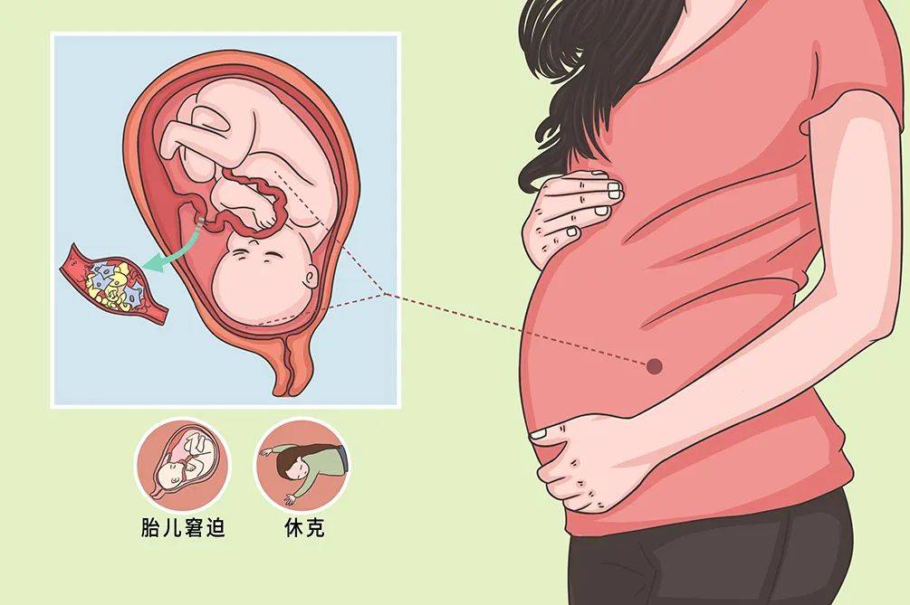 胎盘早剥的前期征兆