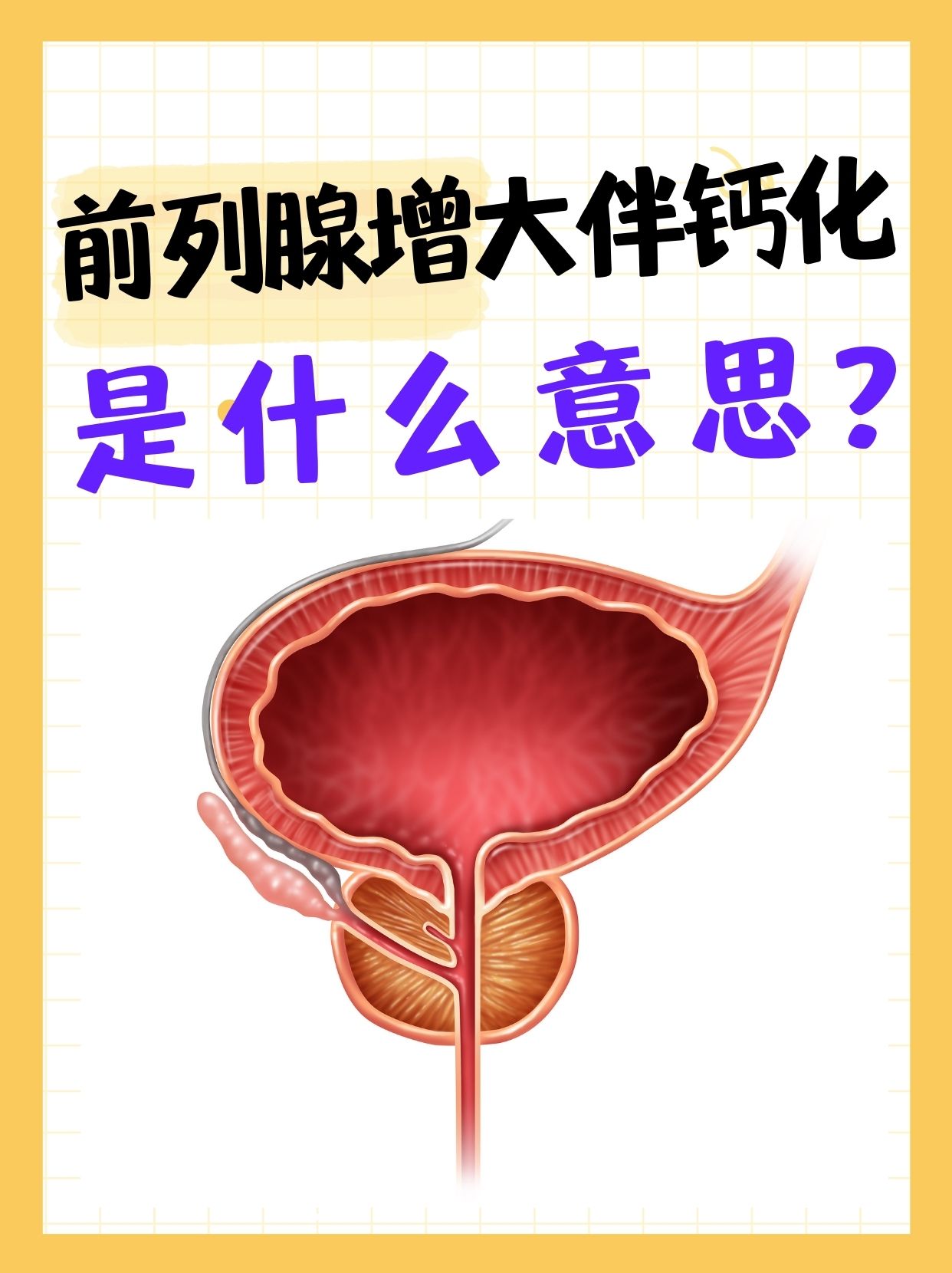 前列腺钙化严重吗