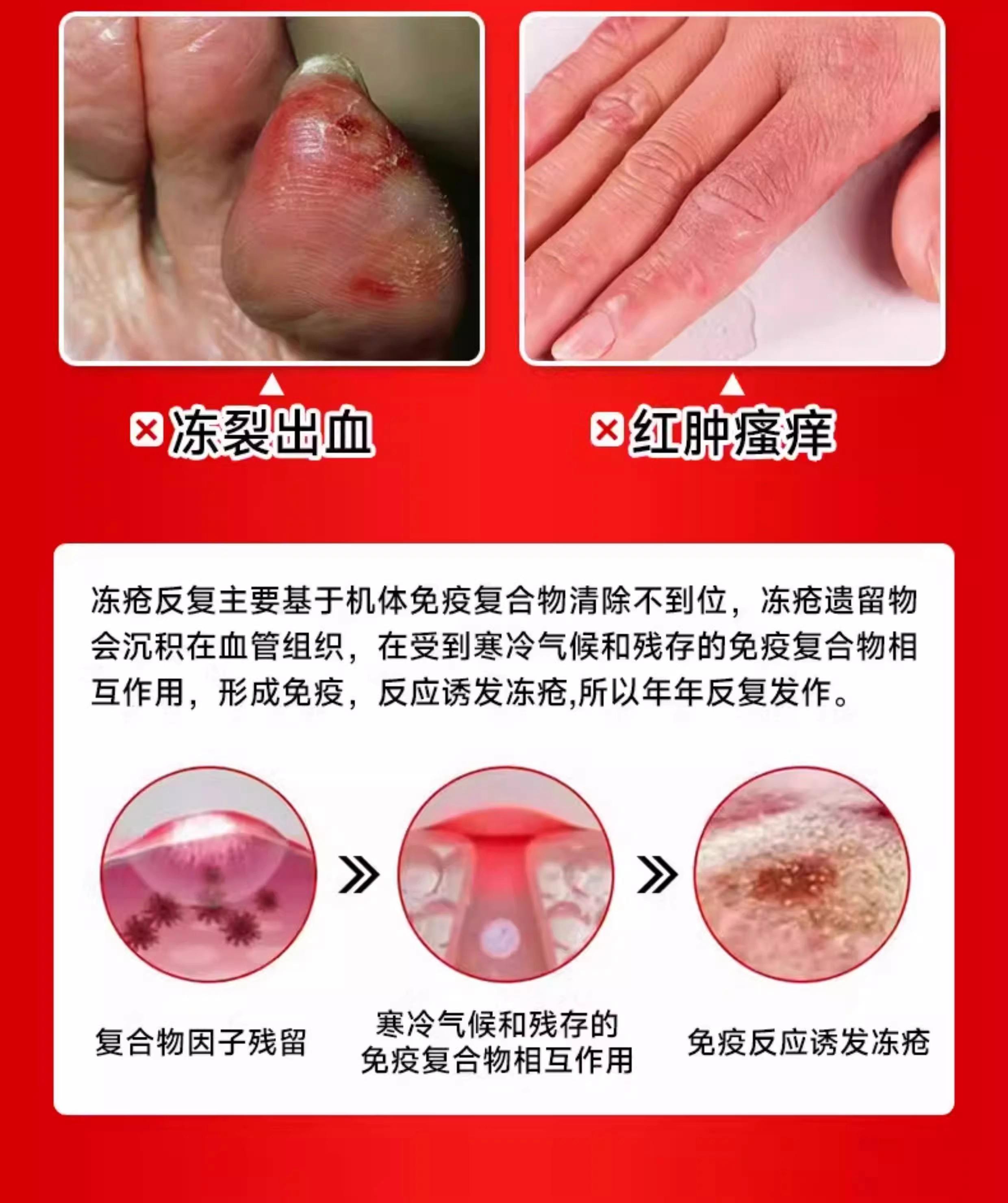 生冻疮怎么办