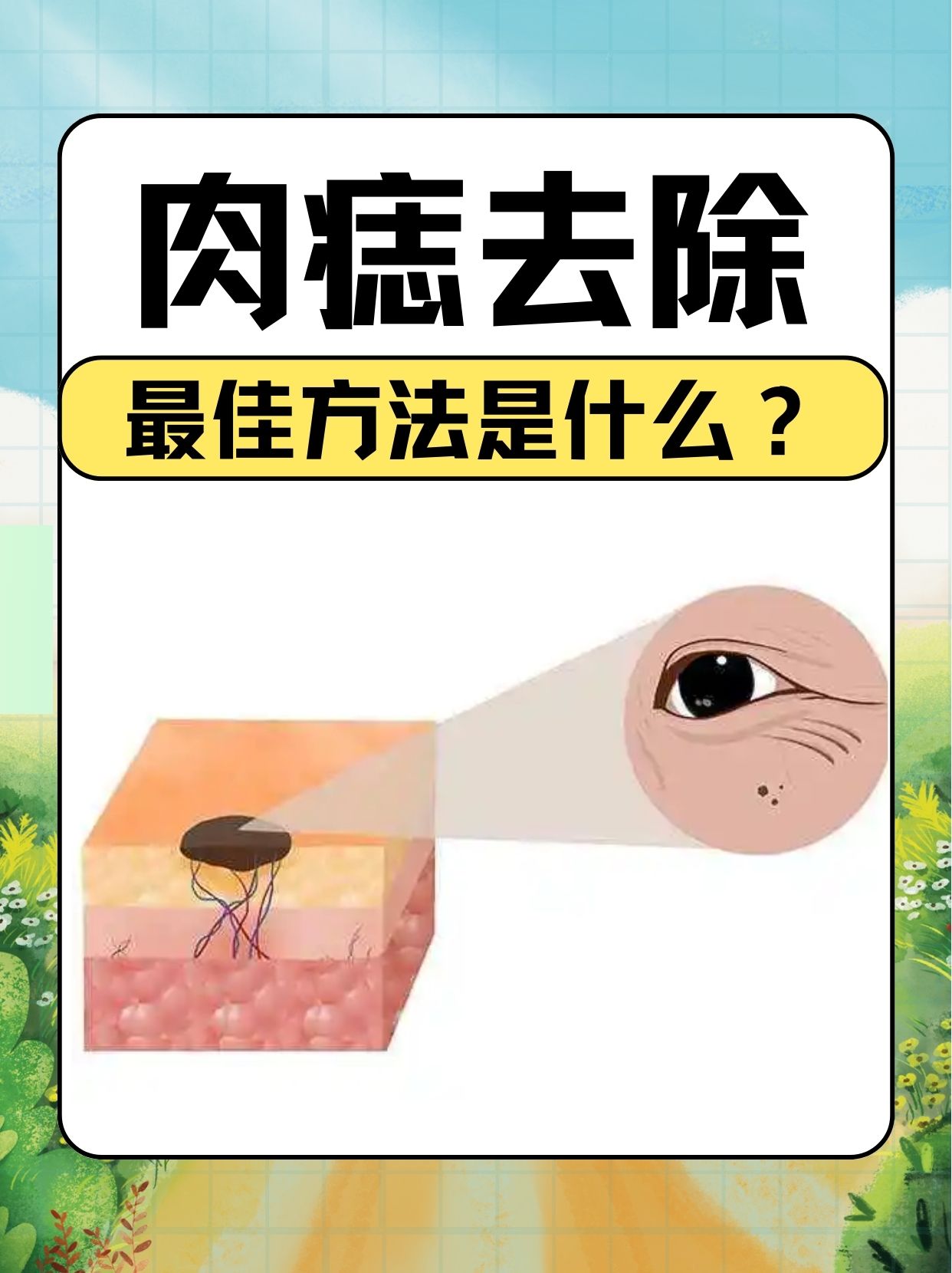 去痦子的妙招有哪些