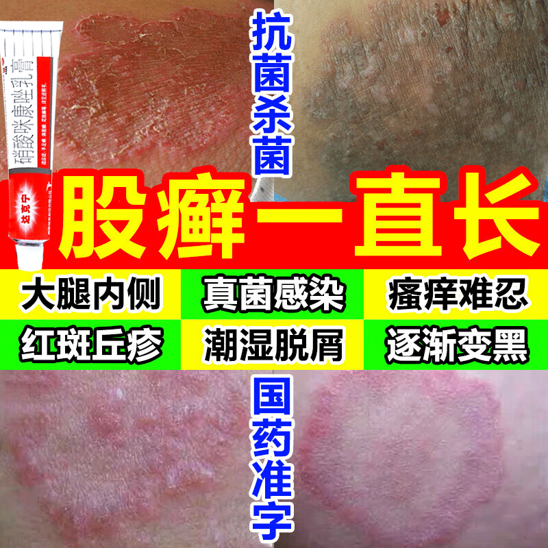 股癣如何用药?
