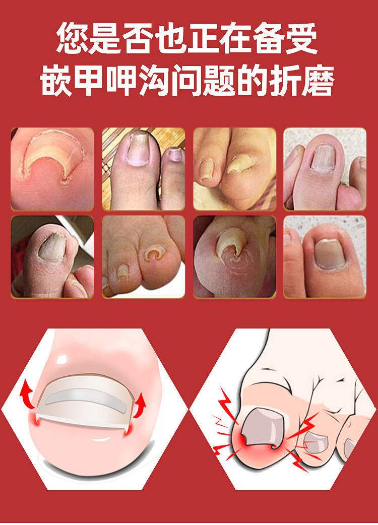 得了甲沟炎怎样治疗才能好得快