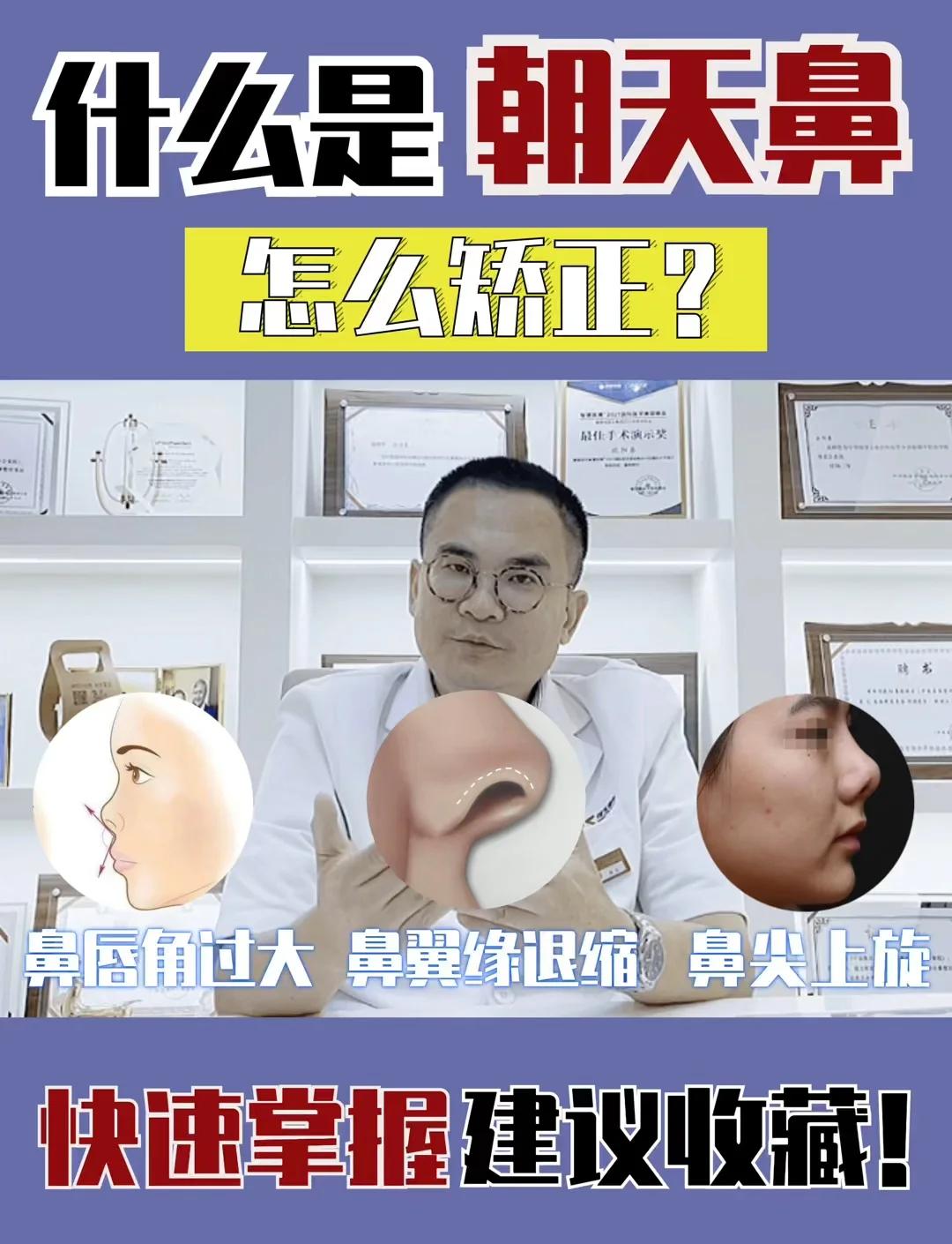 朝天鼻怎么矫正?