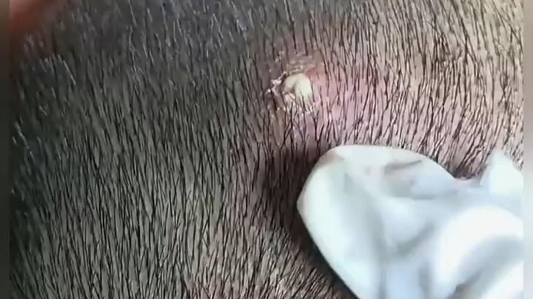 头皮上长小红疙瘩是什么原因?