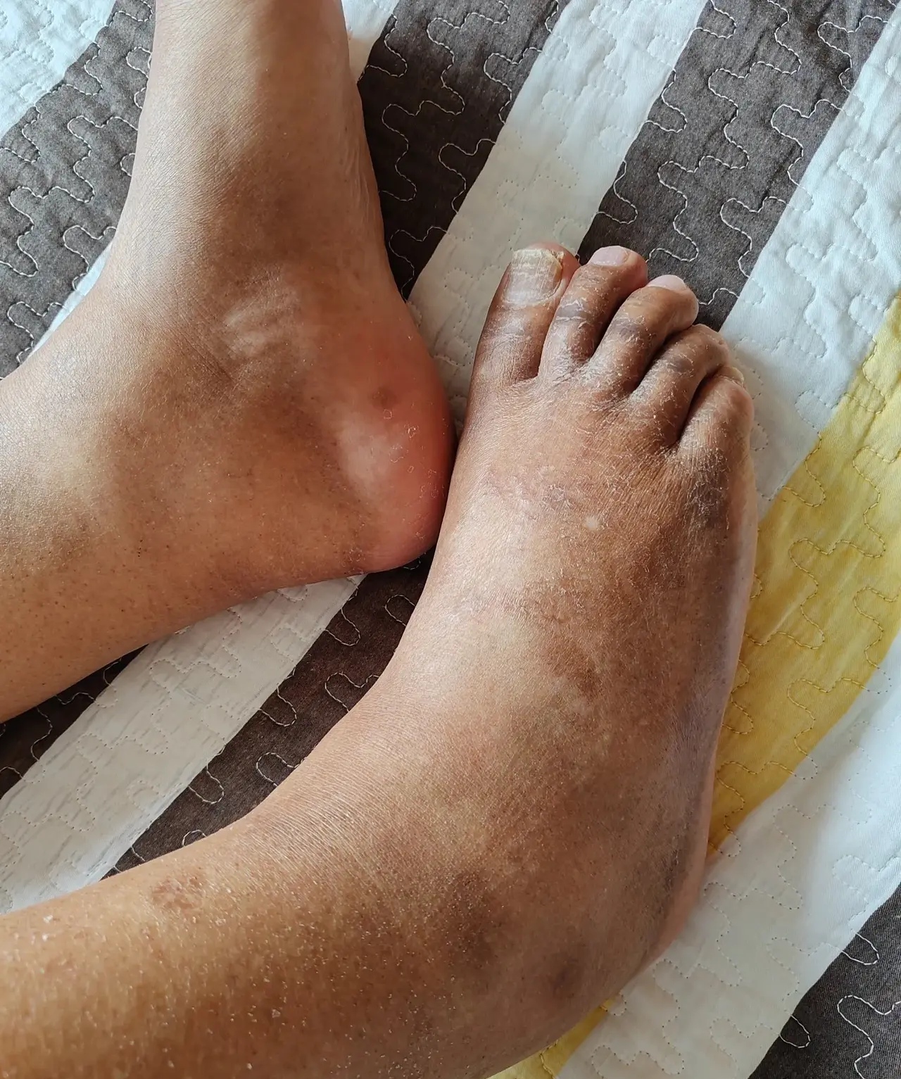 老年人脚肿是怎么回事