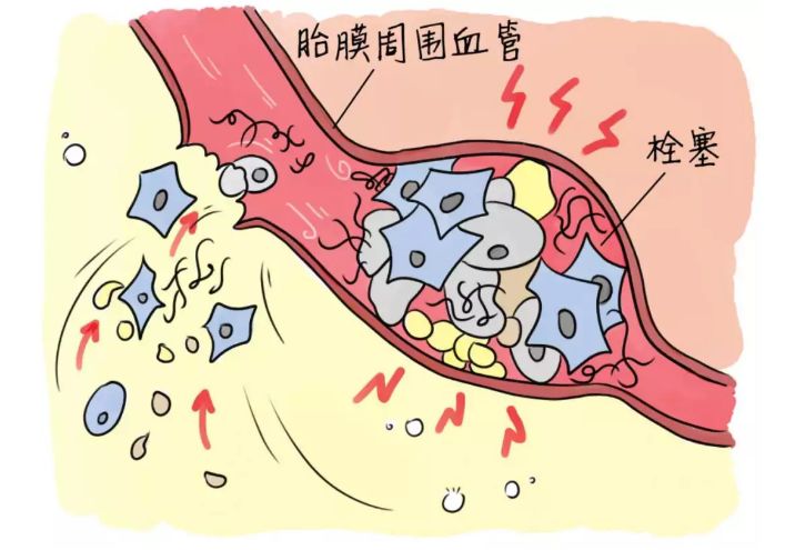 剖宫产会羊水栓塞吗