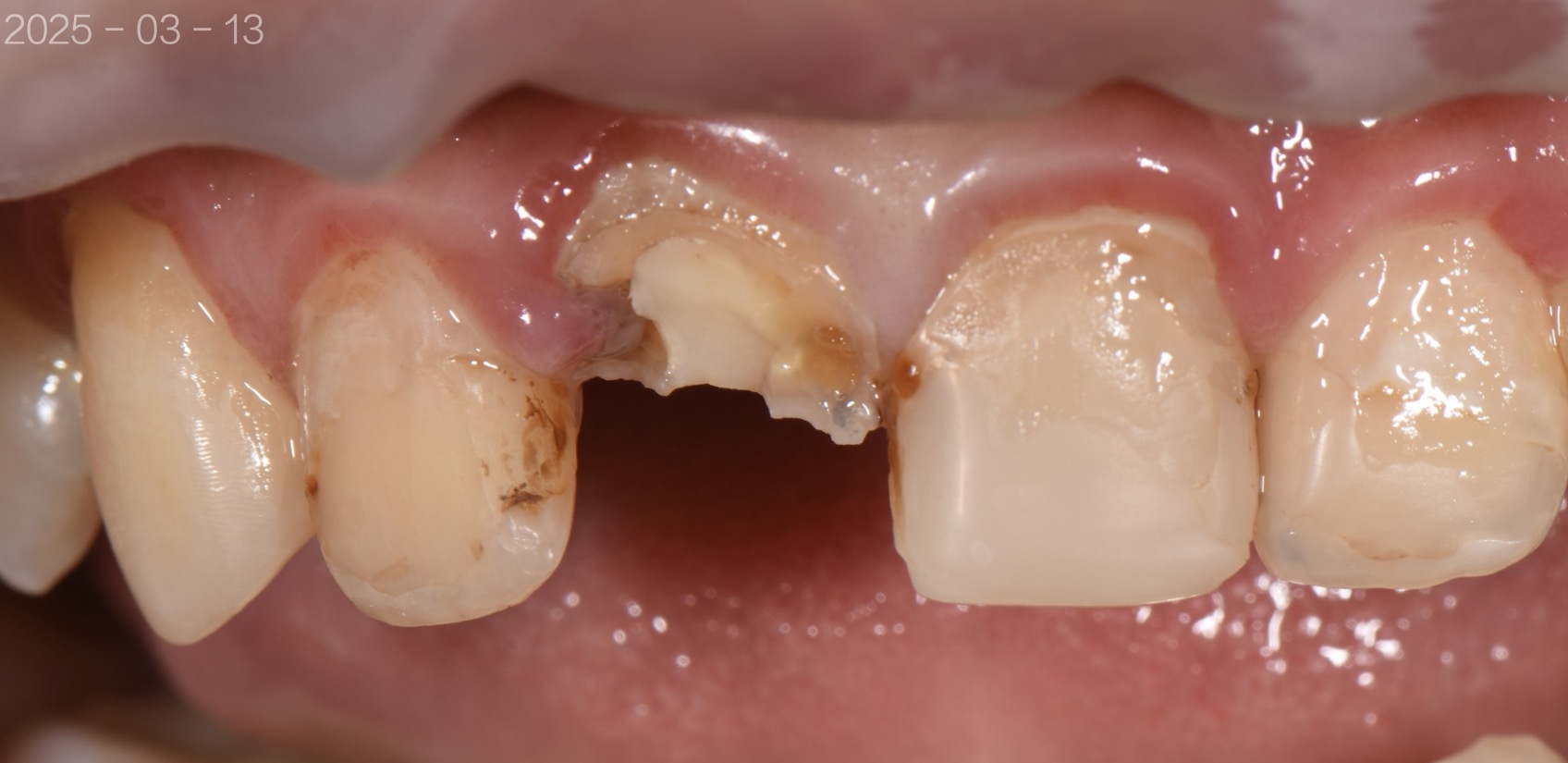 两颗门牙烤瓷牙掉了基牙腐烂