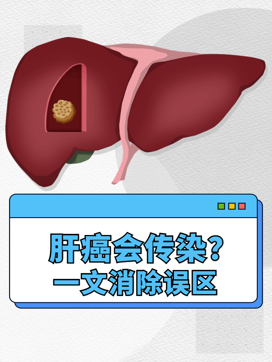 肝癌会传染给别人吗