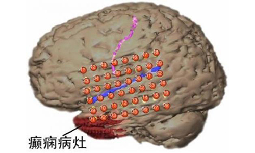 原发性癫痫有哪些