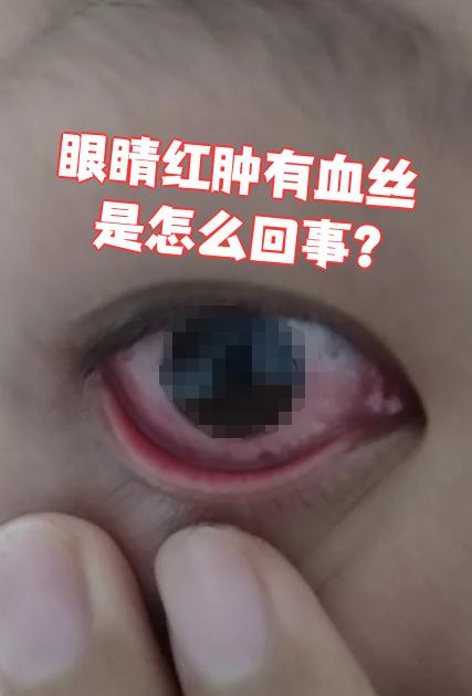 小孩眼睛有红血丝