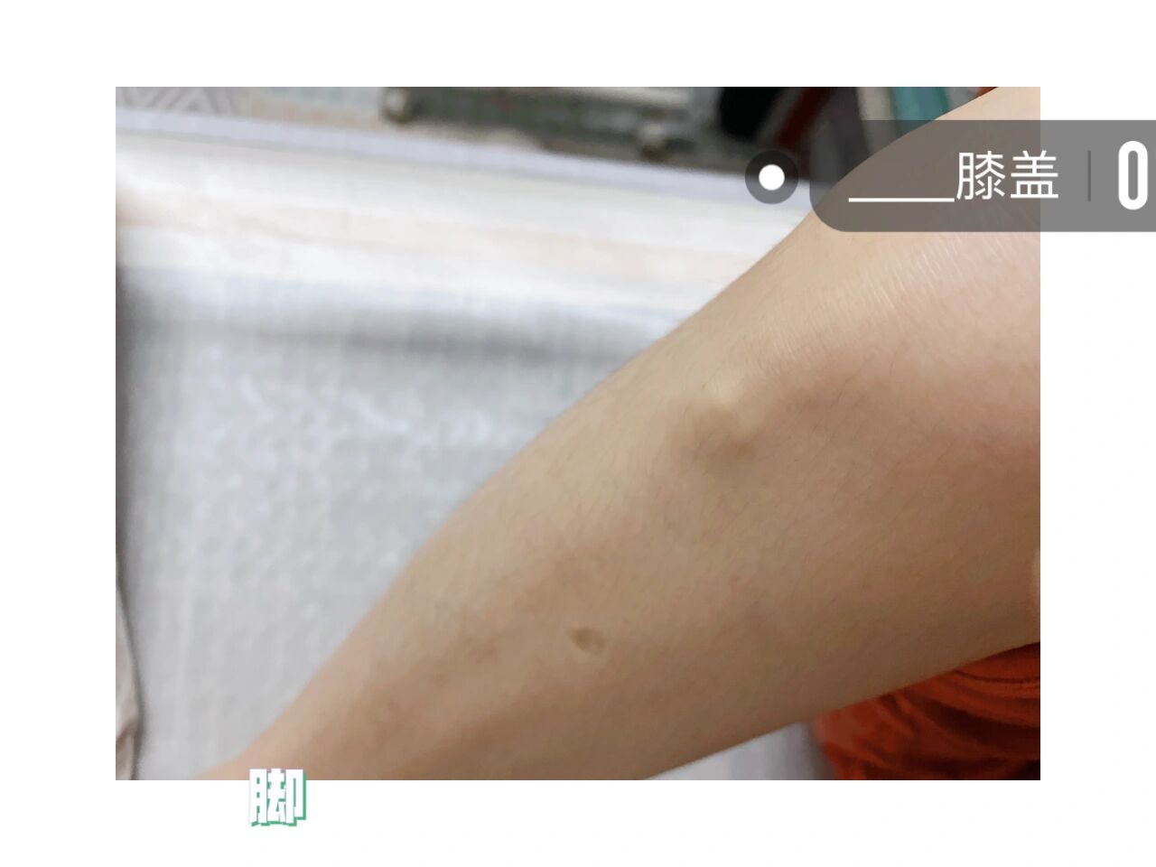 膝盖骨头突出