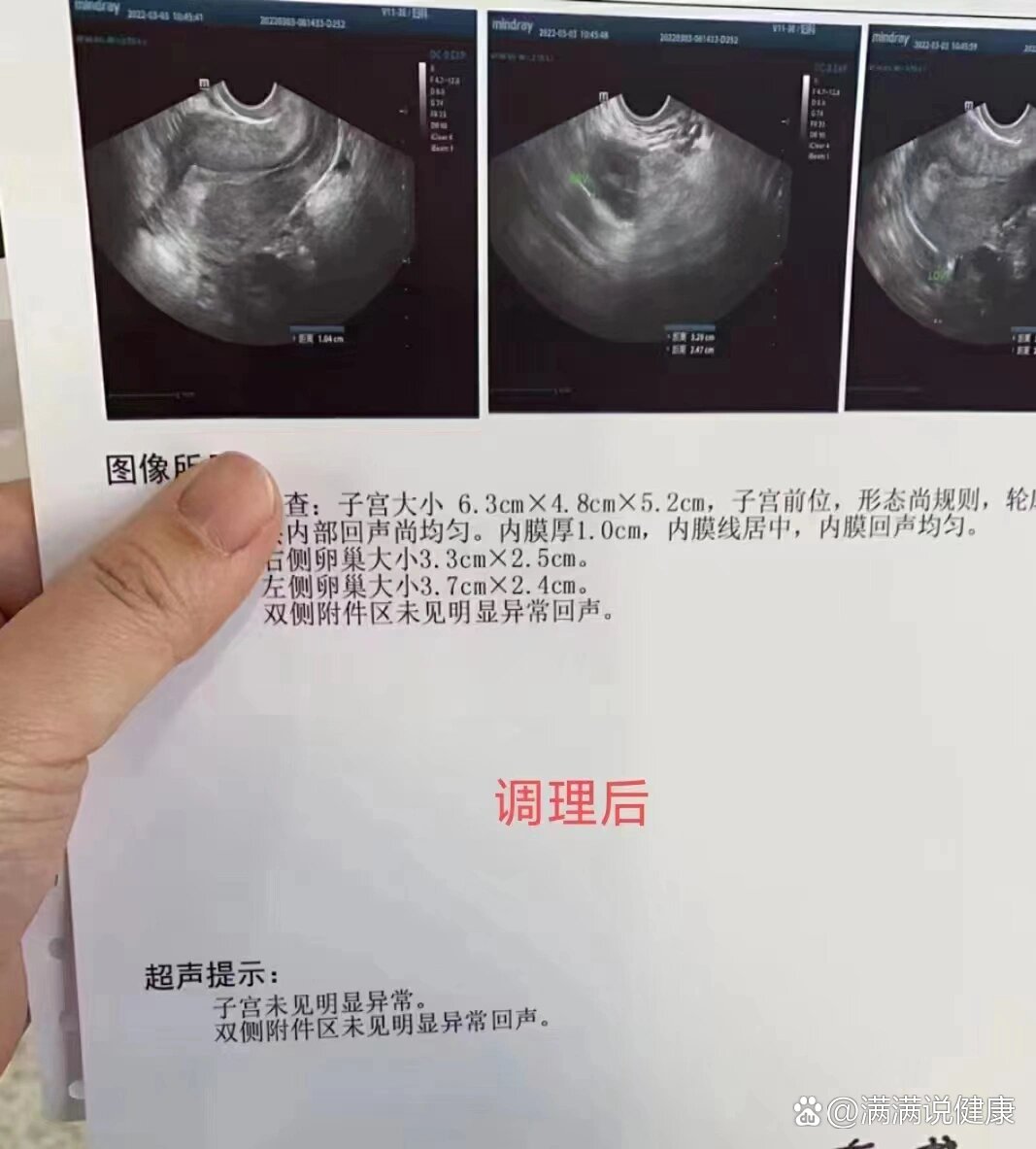 子宫肌瘤可以治愈吗