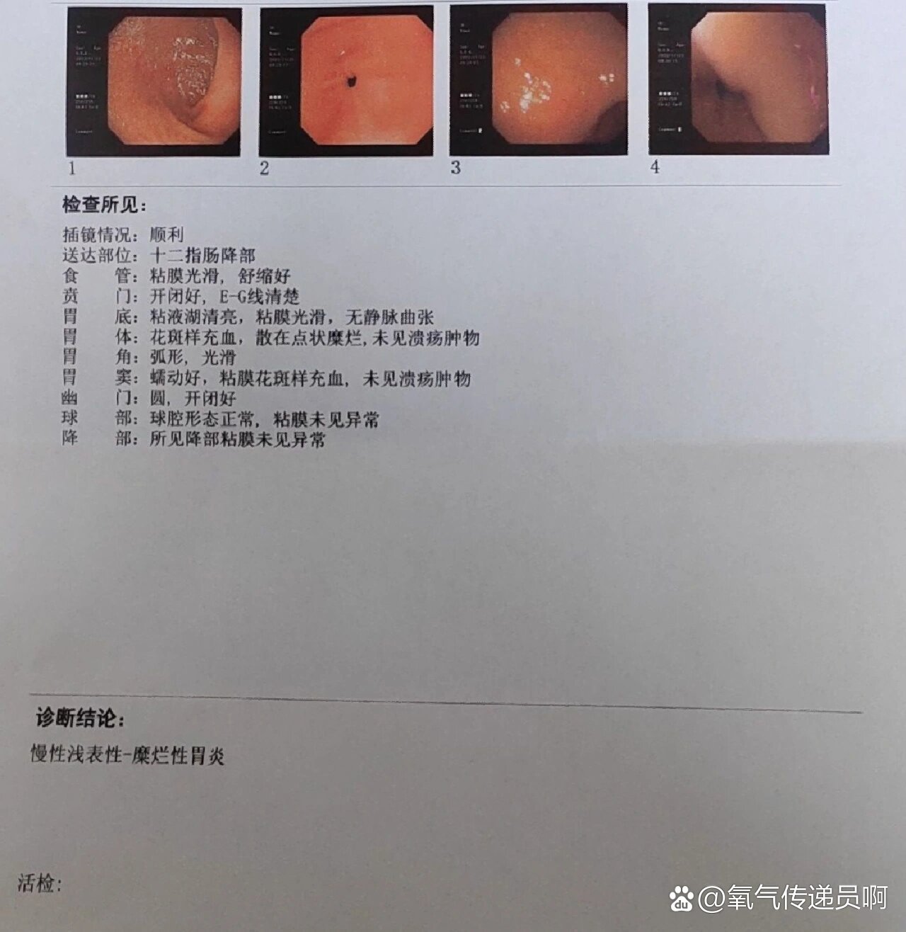 慢性糜烂性胃炎严重吗