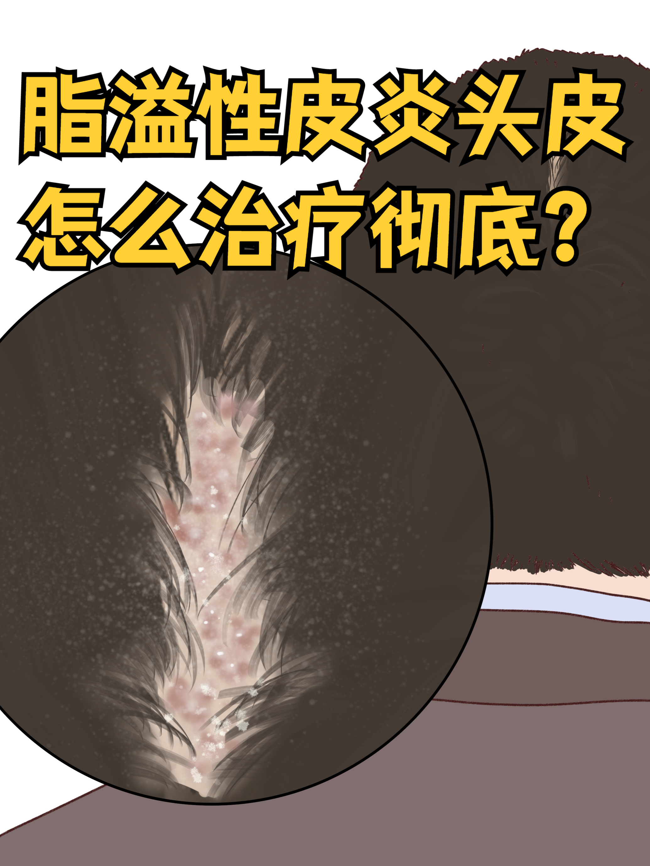 脂溢性湿疹是什么病