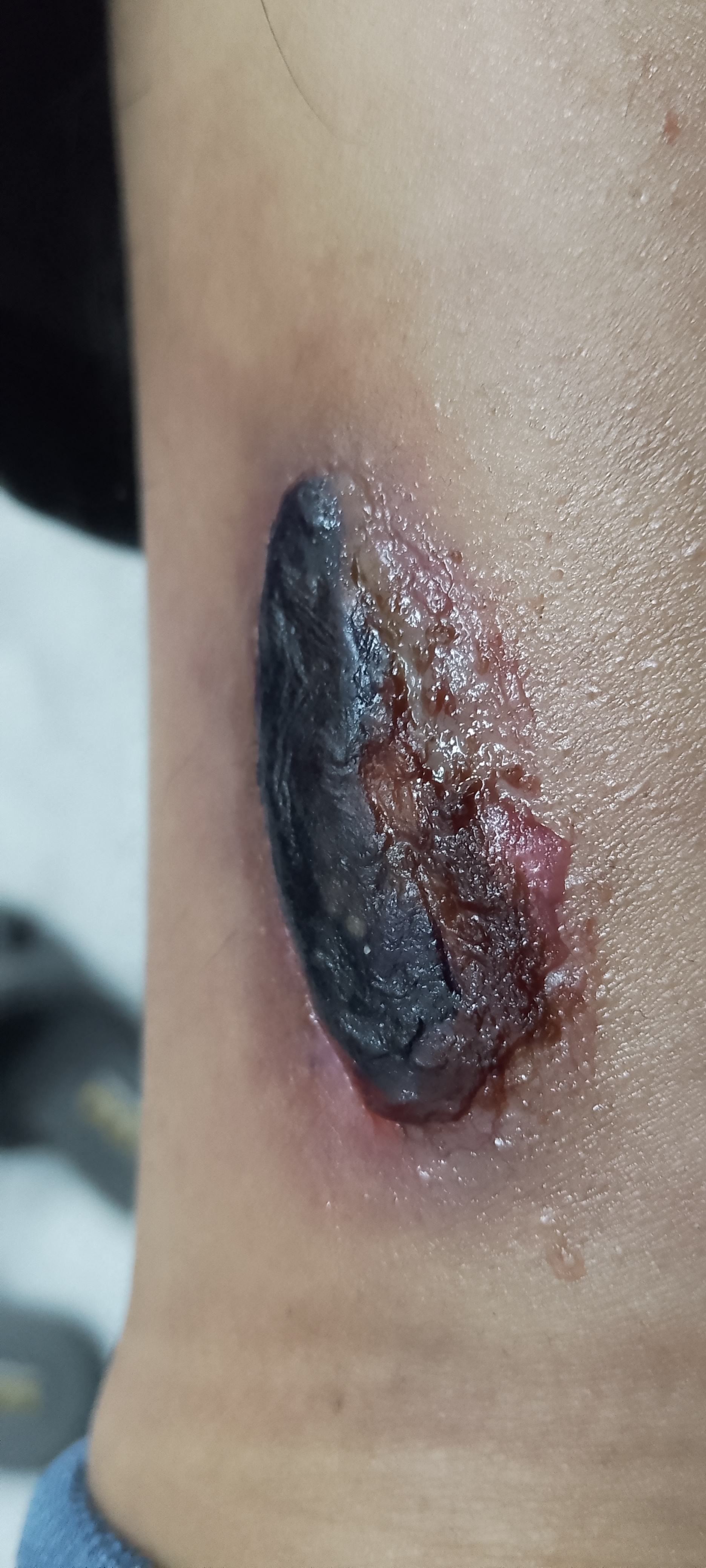 伤口发炎化脓怎么办