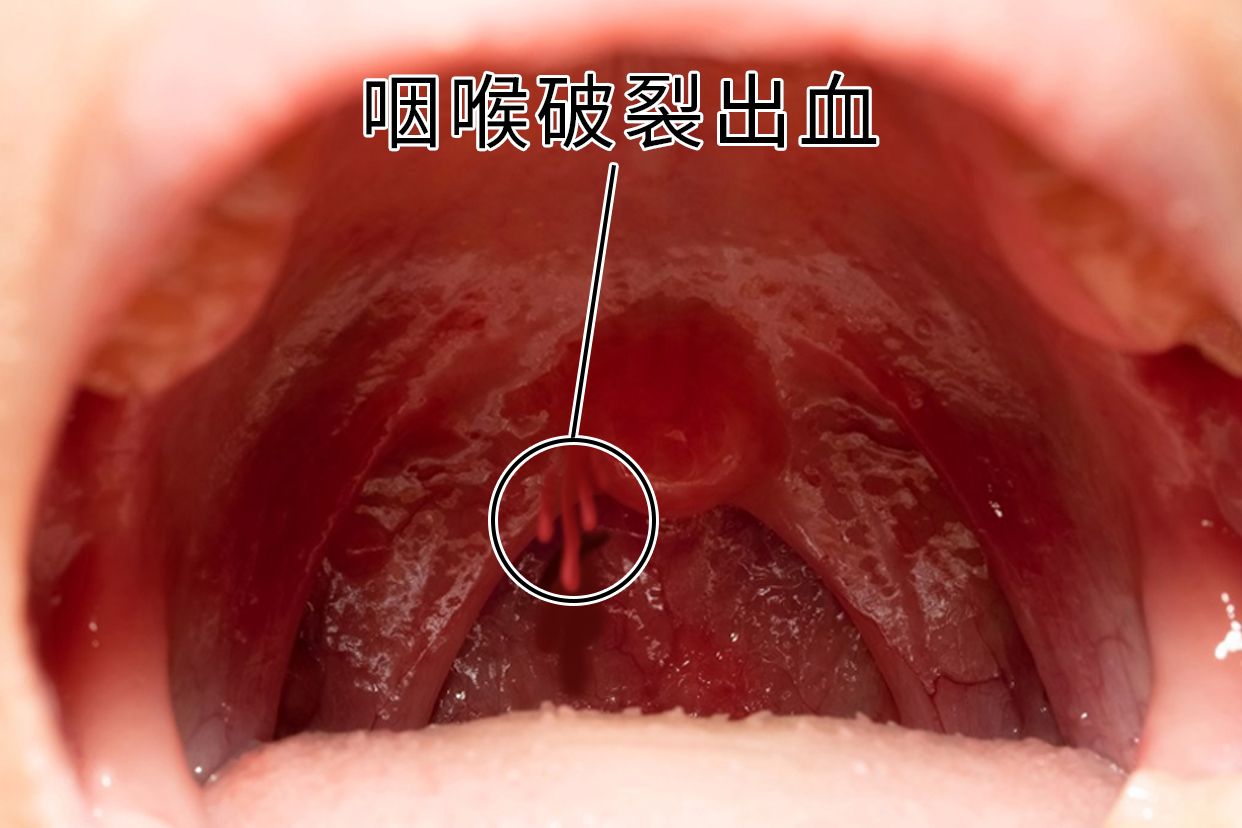 咽喉出血是什么原因