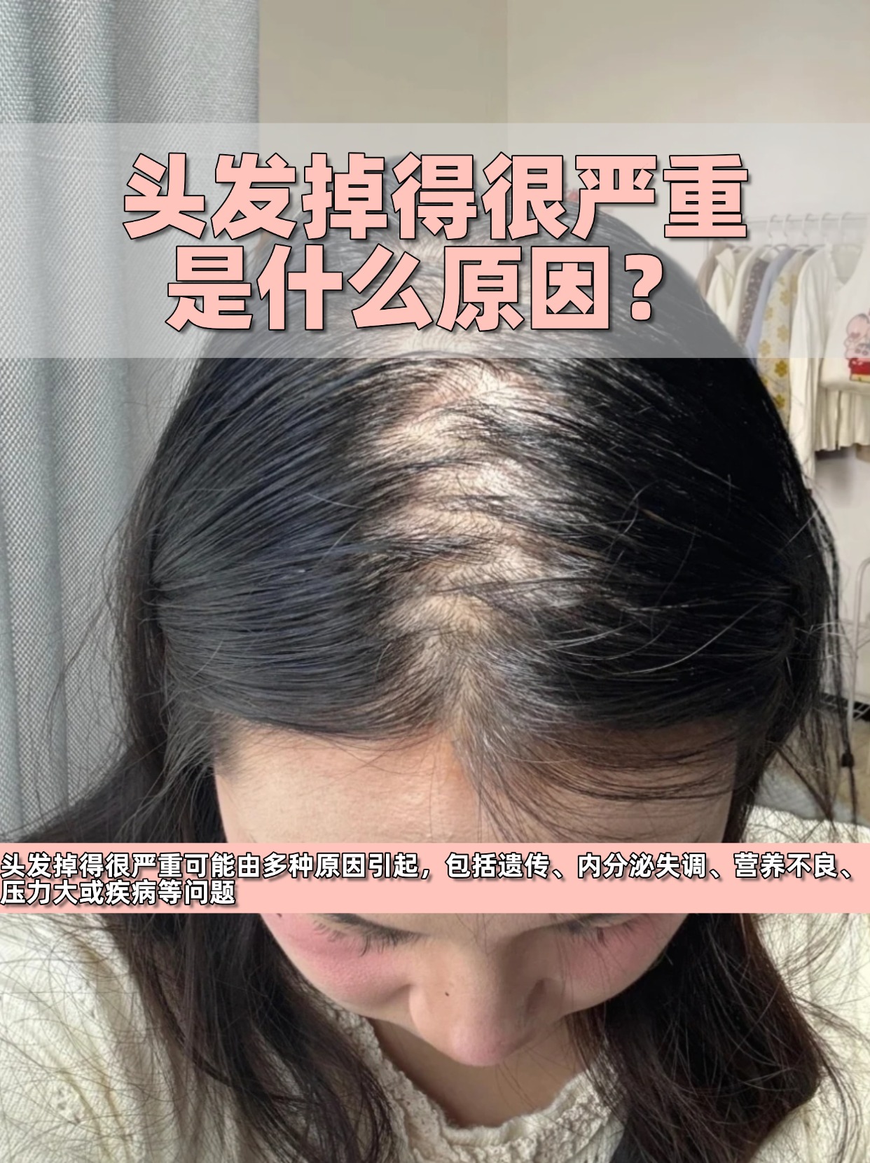 女性脱发是什么原因造成的