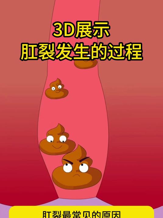 肛裂,可以自愈吗?